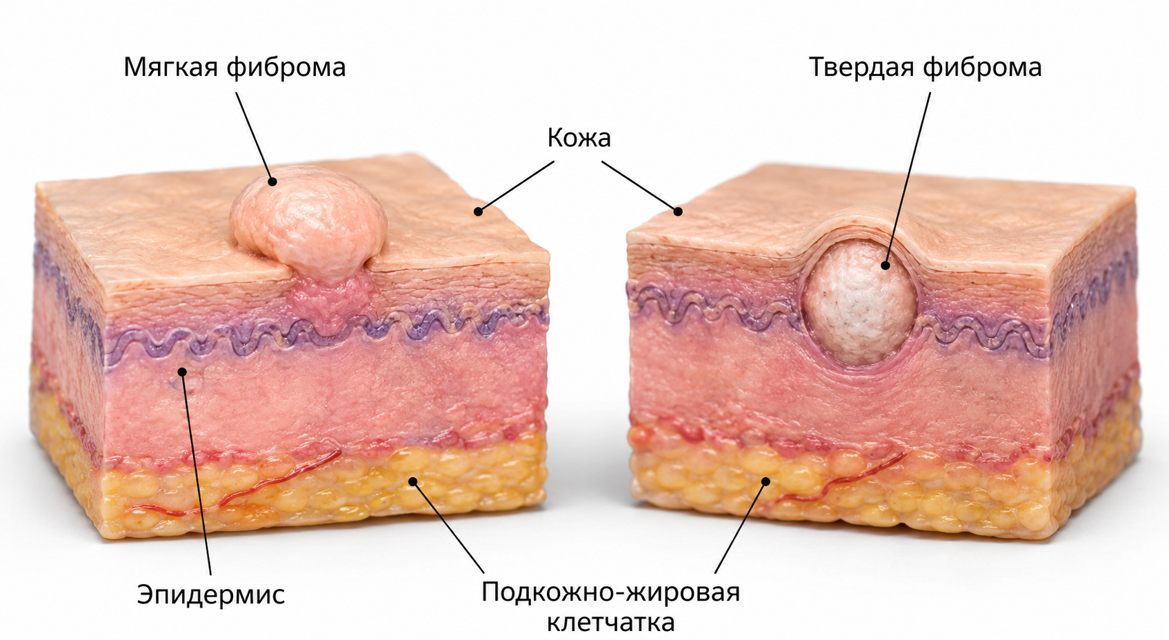 Фиброма может выступать над уровнем кожи или располагаться подкожно фиброма