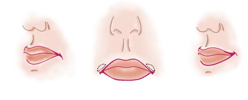 хейлопластика подъем уголков рта