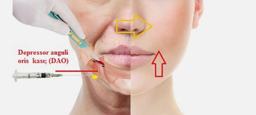 хейлопластика резекция мышцы опускающей угол рта