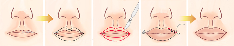 хейлопластика увеличние красной каймы губ 