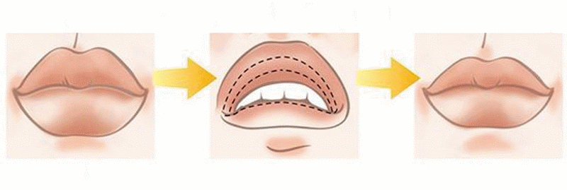 хейлопластика уменьшение красной каймы губ